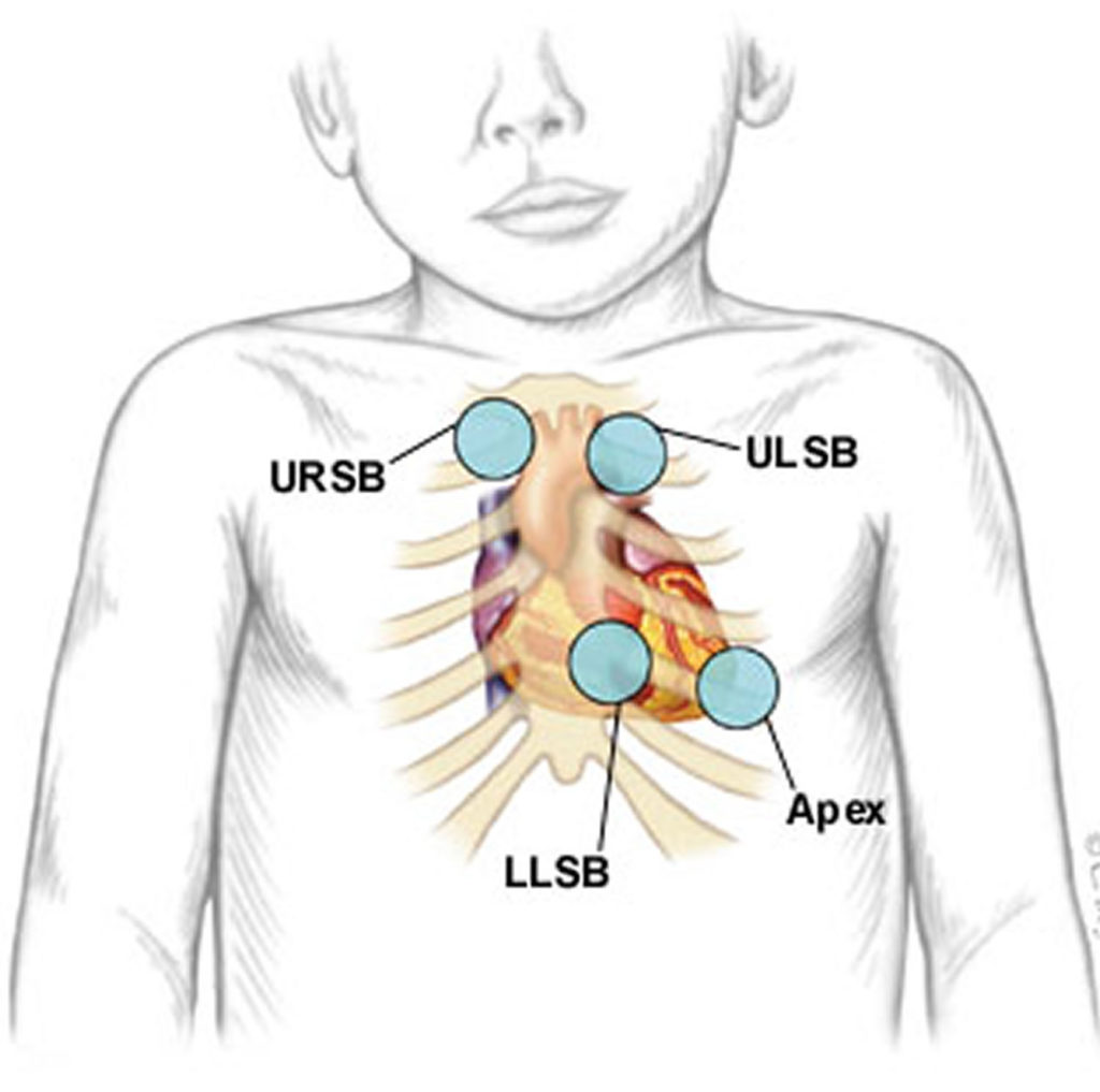 still-s-murmur-definition-still-s-murmur-description-diagnosis