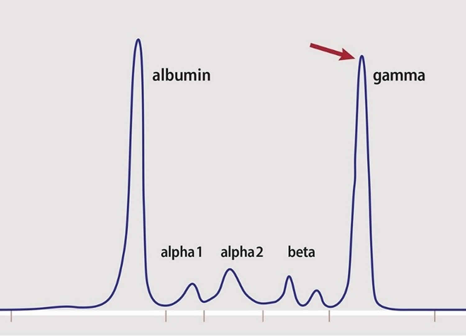 myeloma-protein-multiple-myeloma-protein-test-in-blood-urine