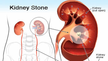 Pyelolithotomy