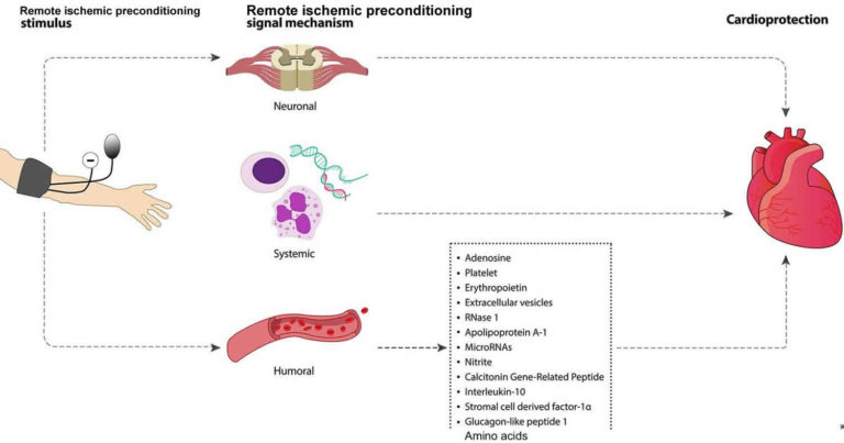 Ischemic Preconditioning & Remote Ischemic Preconditioning