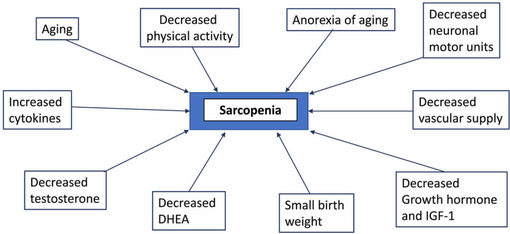 Sarcopenia Definition, Causes, Symptoms, Diagnosis & Treatment