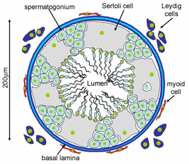 Sertoli cell only syndrome causes, symptoms, diagnosis, treatment ...