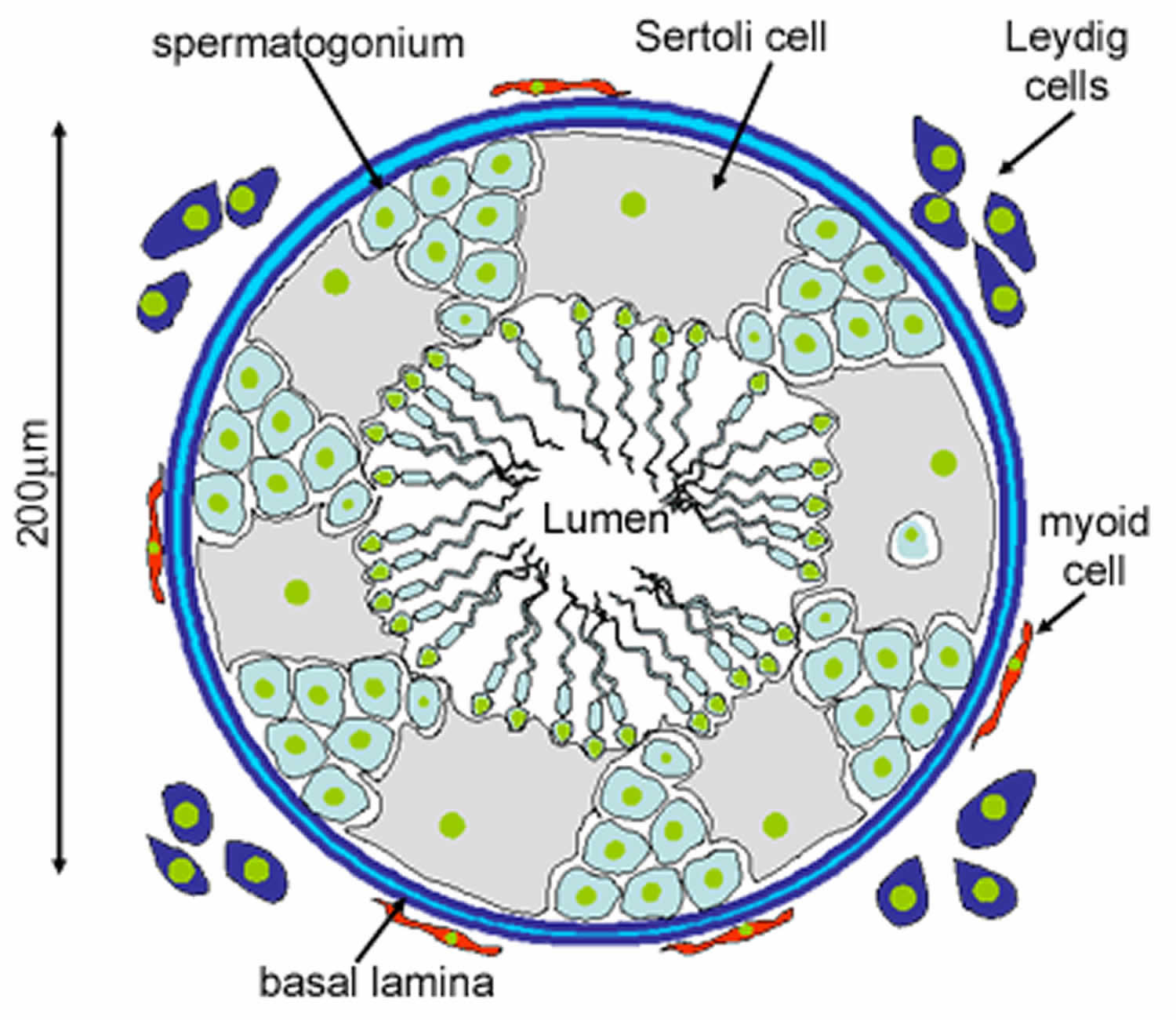 Leydig Cell Tumor Causes Symptoms Diagnosis Treatment Prognosis