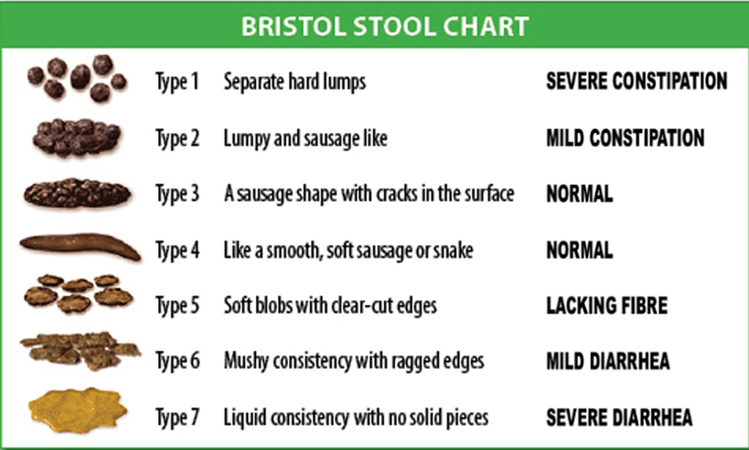 Bristol stool chart or Bristol stool scale