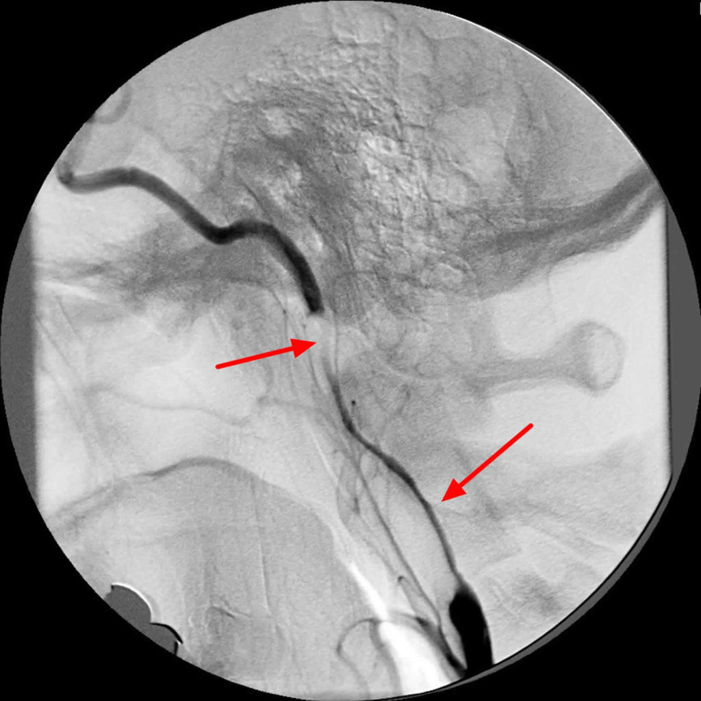 String sign bowel, artery and bone