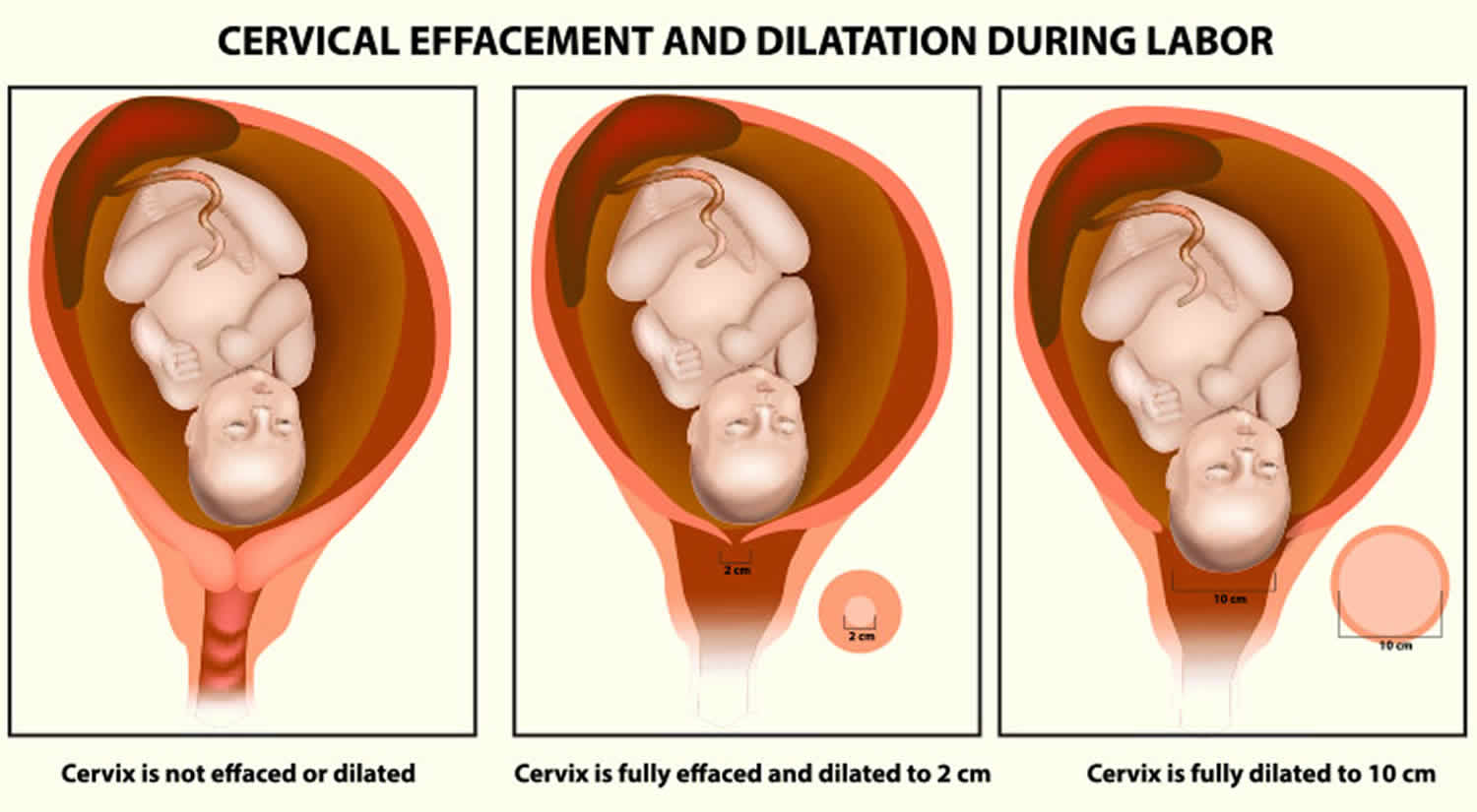 Cervical Effacement Cervix Thinning Signs Your Cervix Is Thinning