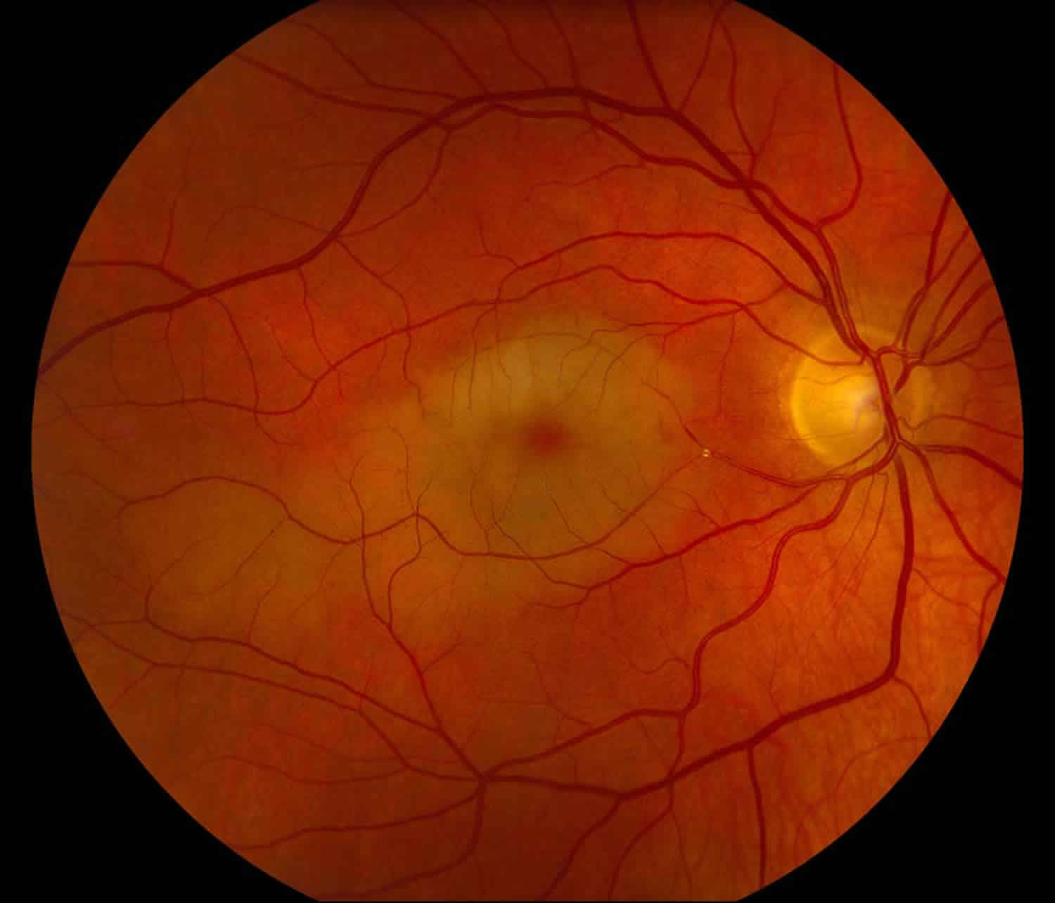 День сетчатки. Ангиоспазм сетчатки глазное дно. Ишемическая нейропатия глазное дно. Центральная Вена сетчатки анатомия.
