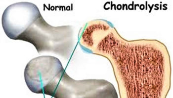 chondrolysis
