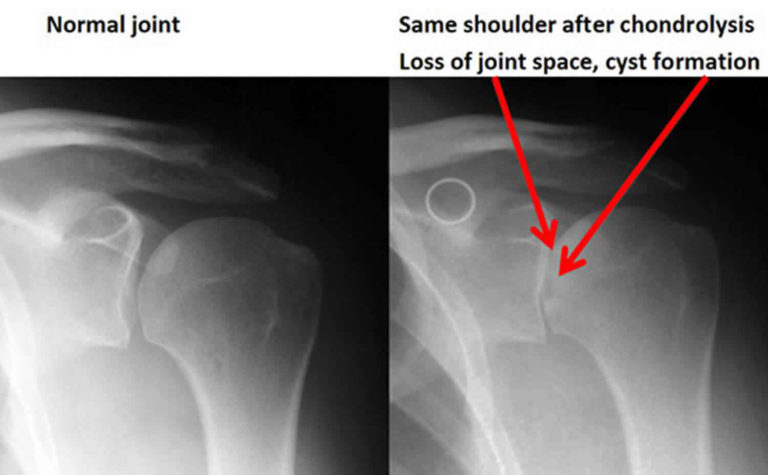 Chondrolysis, Idiopathic Chondrolysis Of The Hip & Chondrolysis Shoulder