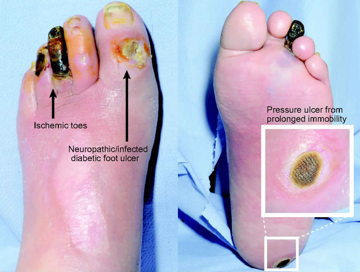 Diabetic Foot Blisters: What you need to know - Podimetrics