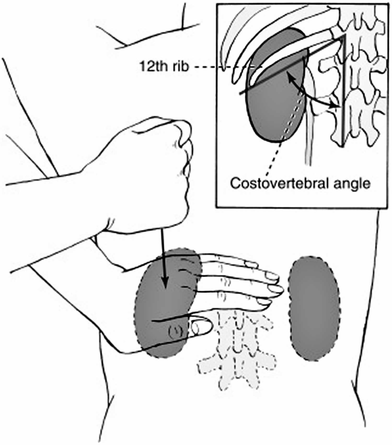 costovertebral-angle-definition-costovertebral-angle-tenderness-test