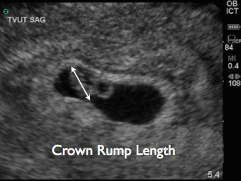 crown-rump-length-crown-rump-length-measurement-crown-rump-length