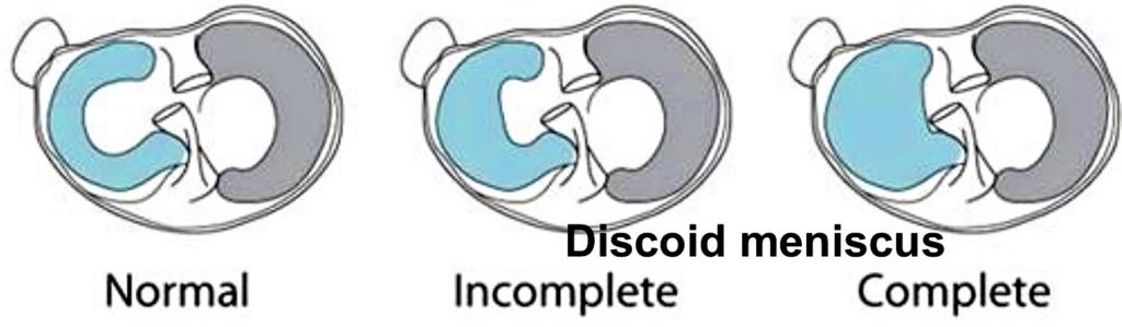 Discoid meniscus causes, symptoms, diagnosis, treatment & prognosis