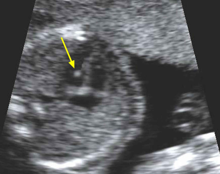 Echogenic intracardiac focus & echogenic intracardiac focus causes