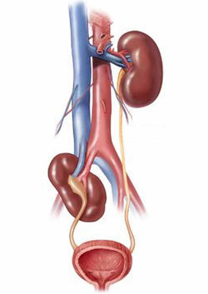 Ectopic kidney renal ectopia causes symptoms diagnosis treatment