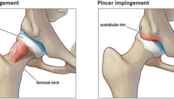 femoroacetabular impingement syndrome