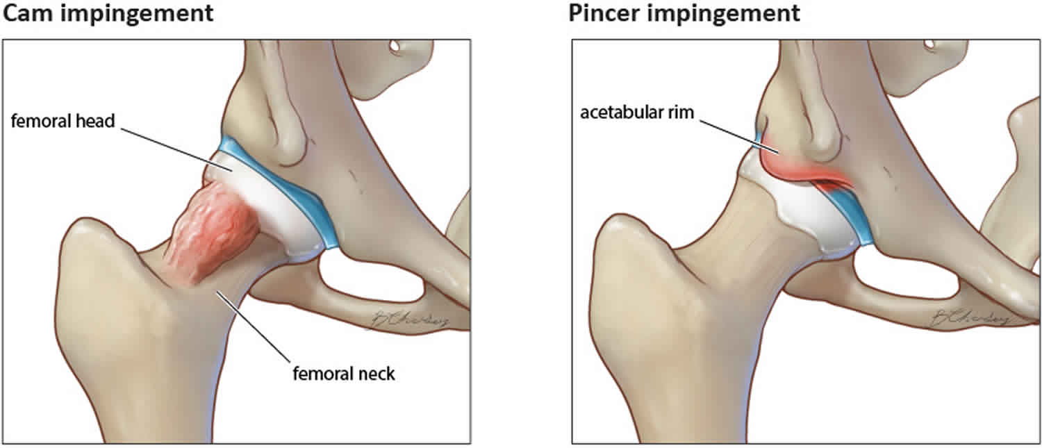 acetabular impingement causes, symptoms, diagnosis & treatment