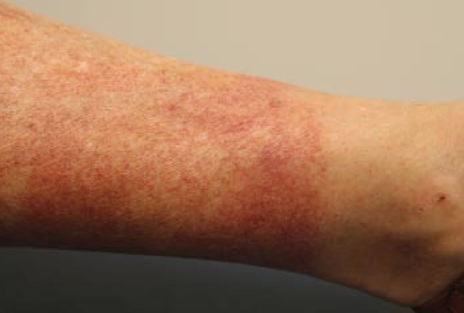 skin-rash-from-hot-springs-at-gertrude-miller-blog