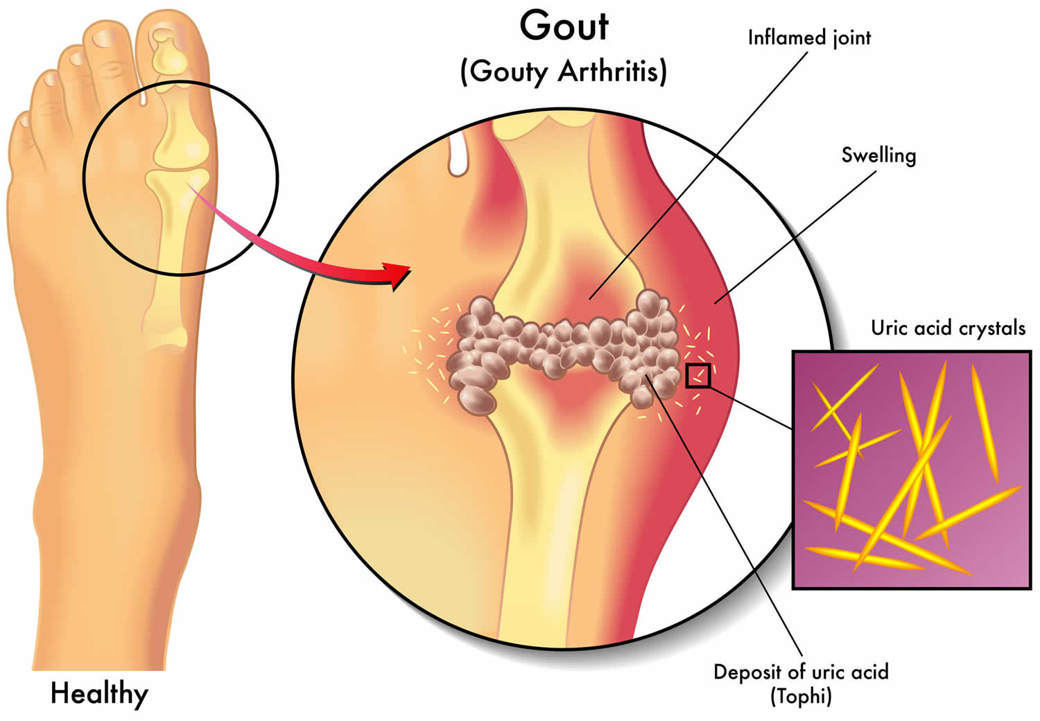 Gouty tophi causes, symptoms, diagnosis & treatment