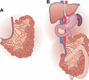 Intestine transplant indications, techniques, complications & prognosis