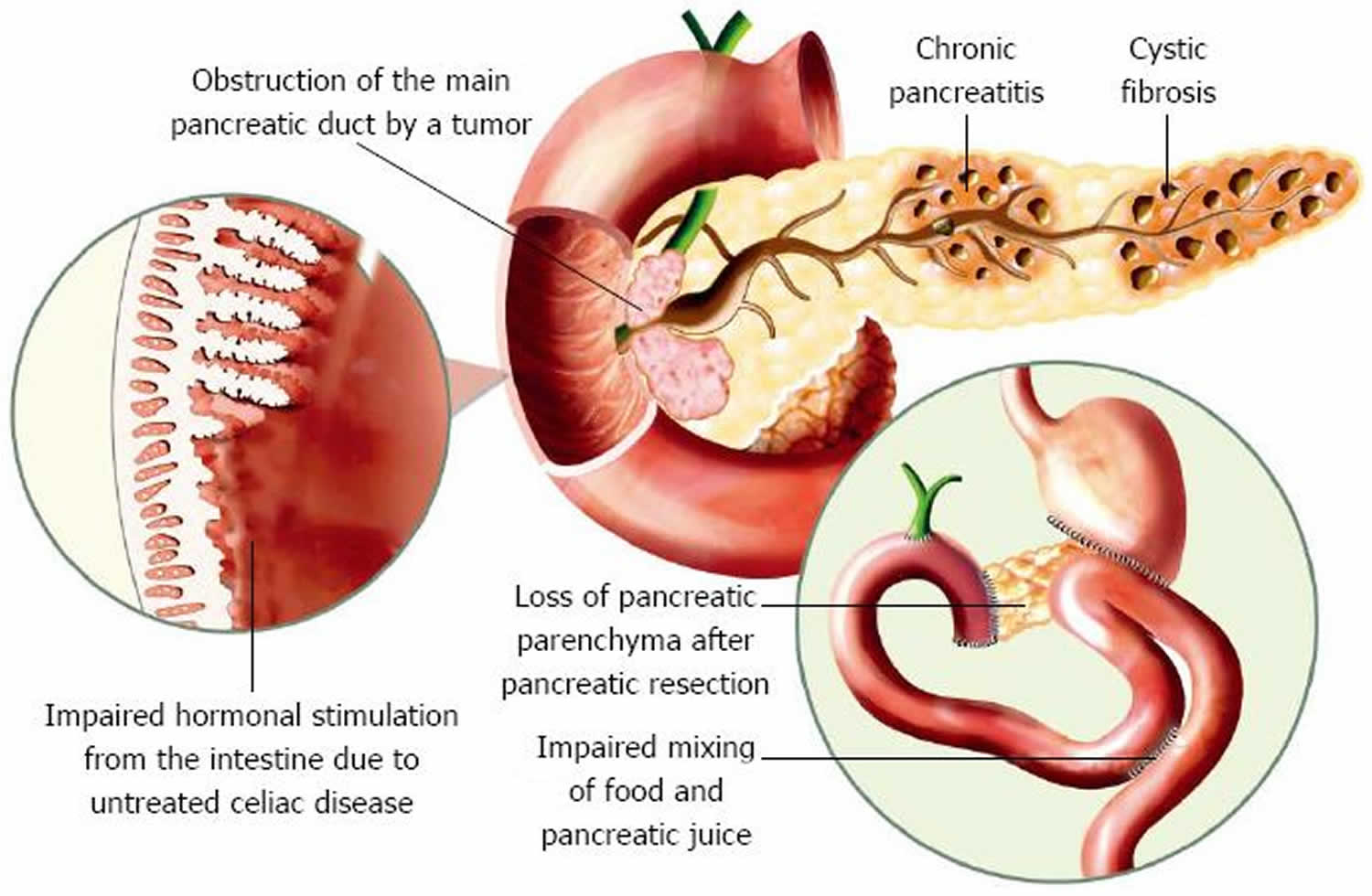 Can Pancreatic Insufficiency Cause Blood In Stool