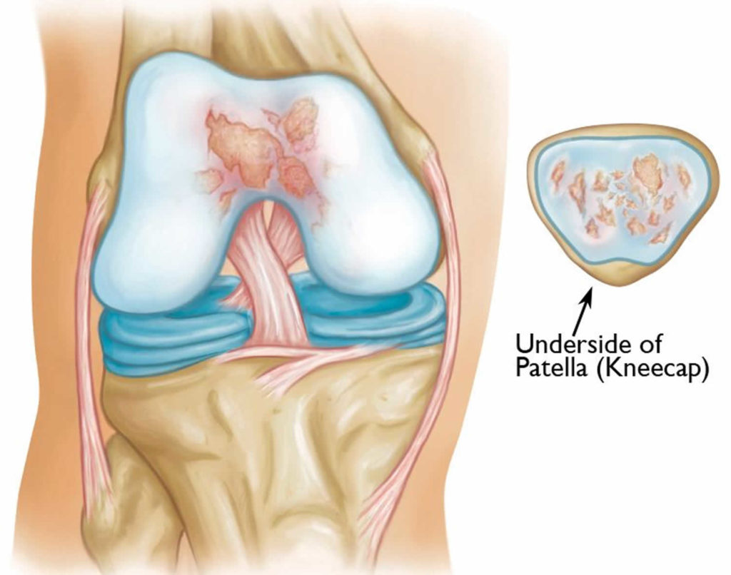 Patellofemoral arthritis causes, symptoms, diagnosis, treatment & prognosis