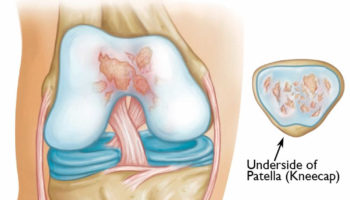 patellofemoral arthritis
