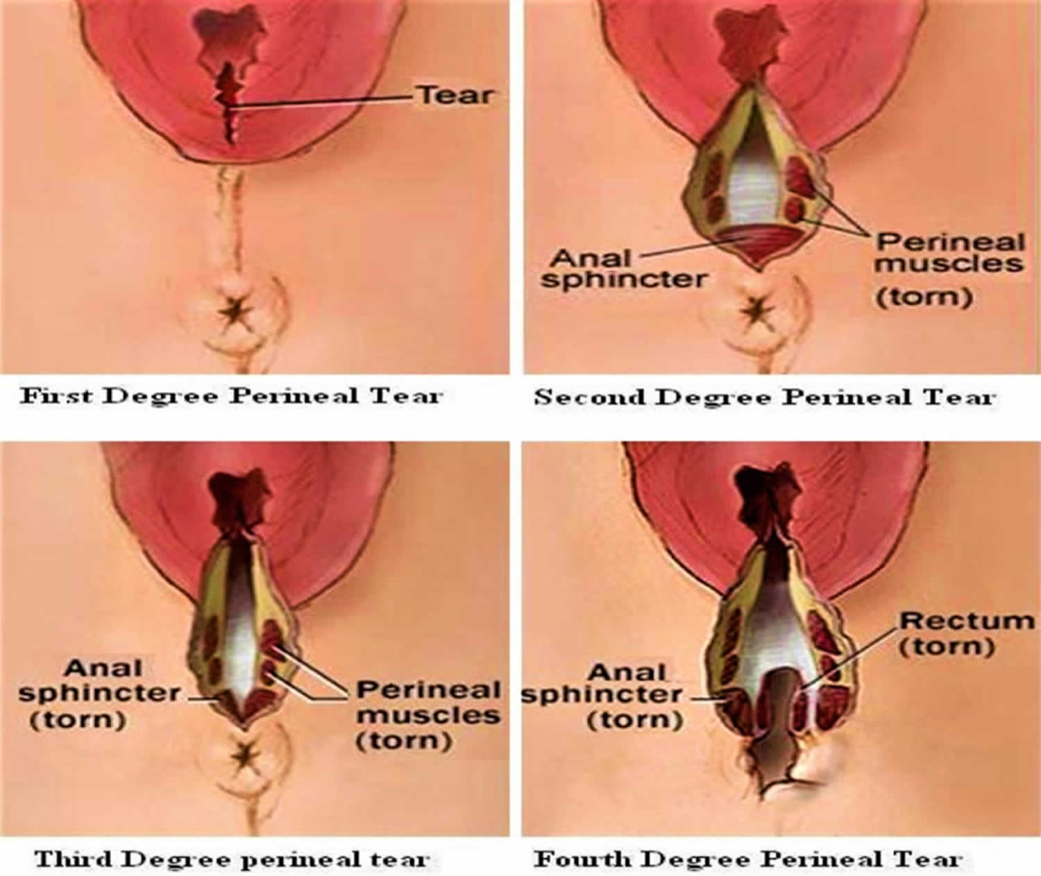 Tears vaginal what are Vaginal Tears/Fissures