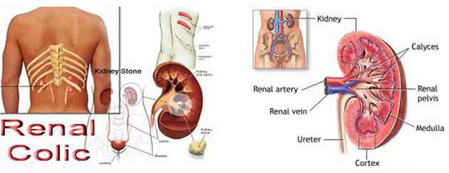 severe colic pain