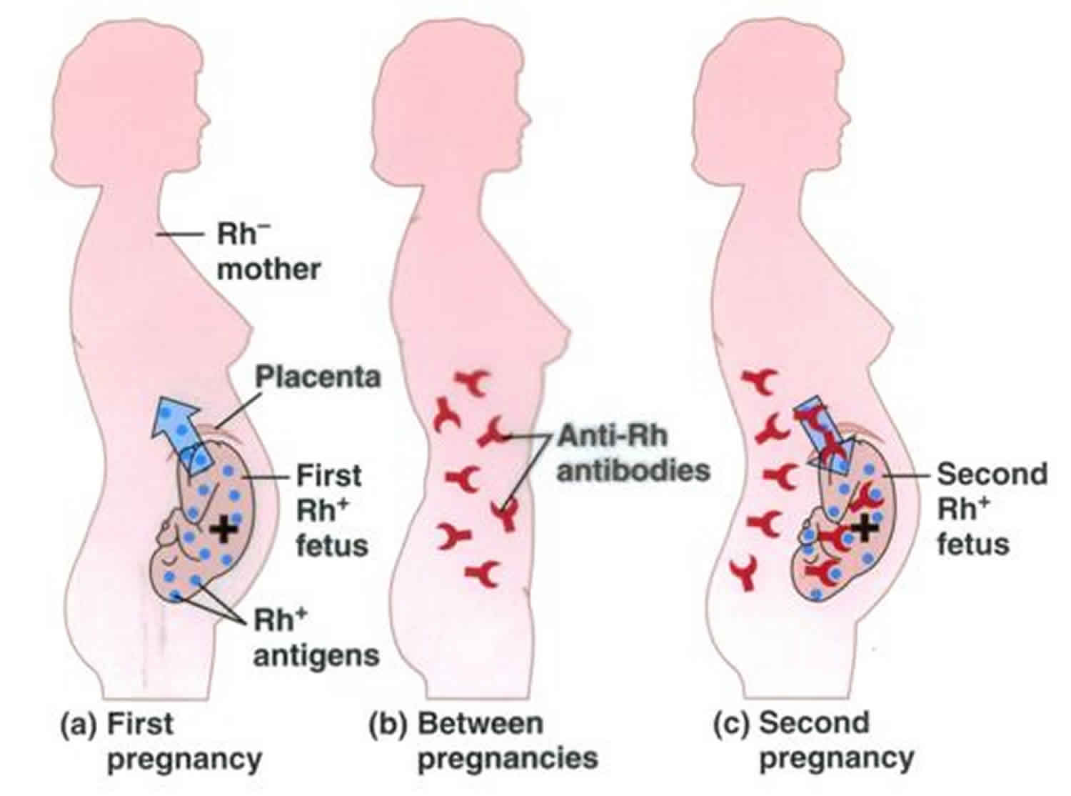 Rhesus Disease Or Rh Disease Causes Prevention Symptoms Treatment 