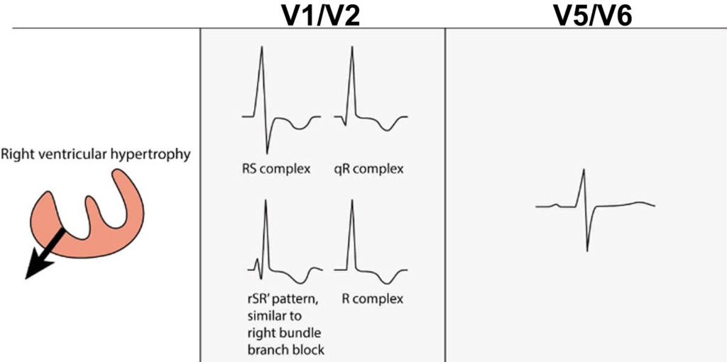 Left Ventricular Hypertrophy With Strain Is Characterized By Which Electrocardiogram Ecg Change