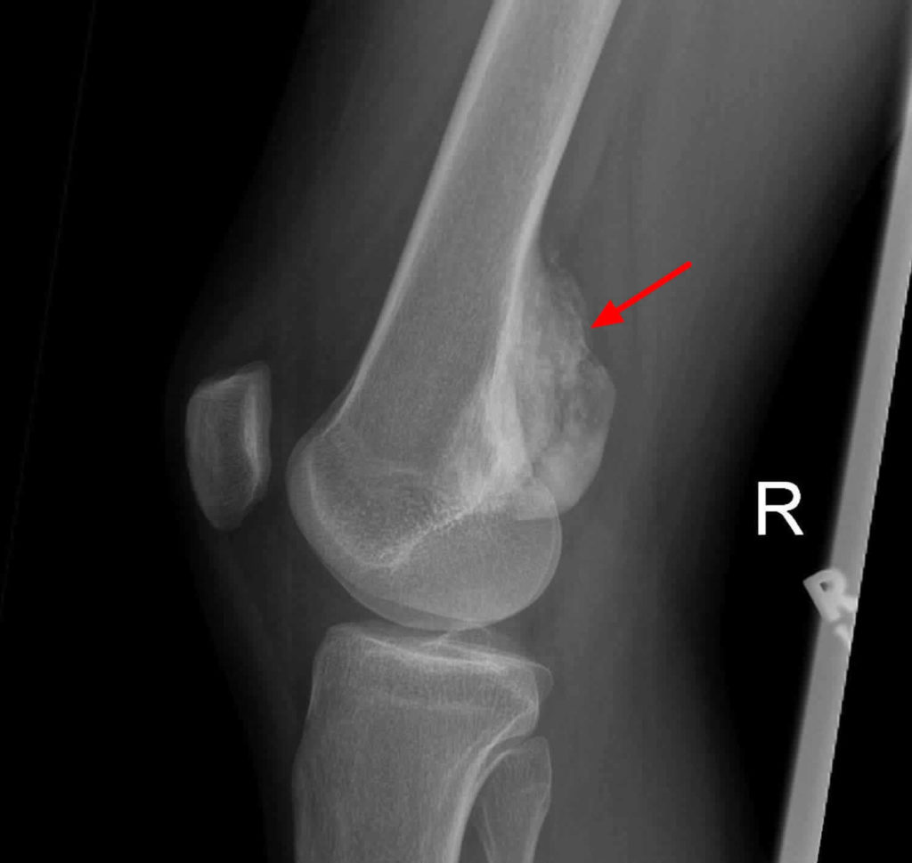 String sign bowel, artery and bone