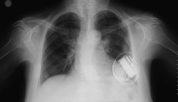 twiddler syndrome