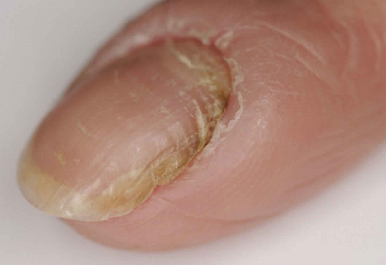 Why Is My Infected Hangnail Green