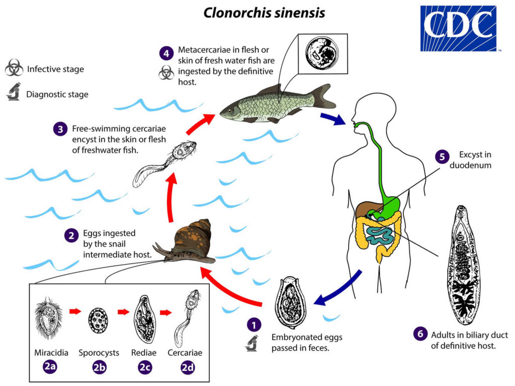 clonorchiasis-clonorchis-sinensis-infection-symptoms-diagnosis