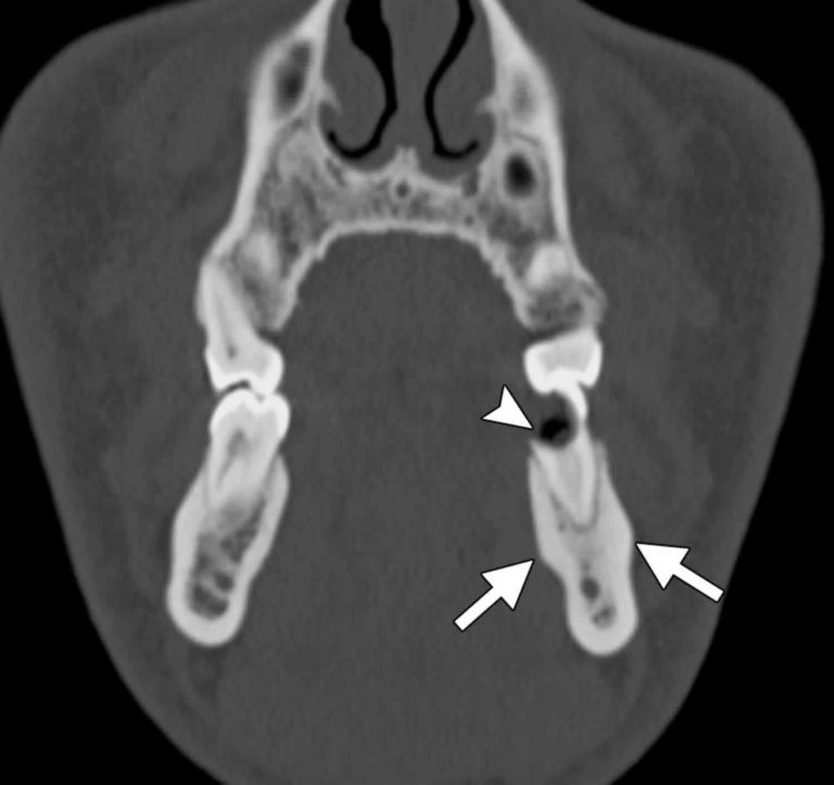 Condensing Osteitis Definition Causes Symptoms Diagnosis And Treatment