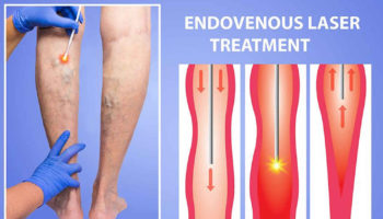 Endovenous laser ablation