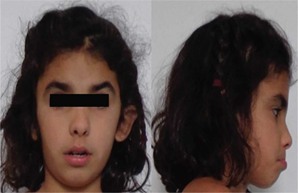 Dysmorphic features, clinical assessment & what to do