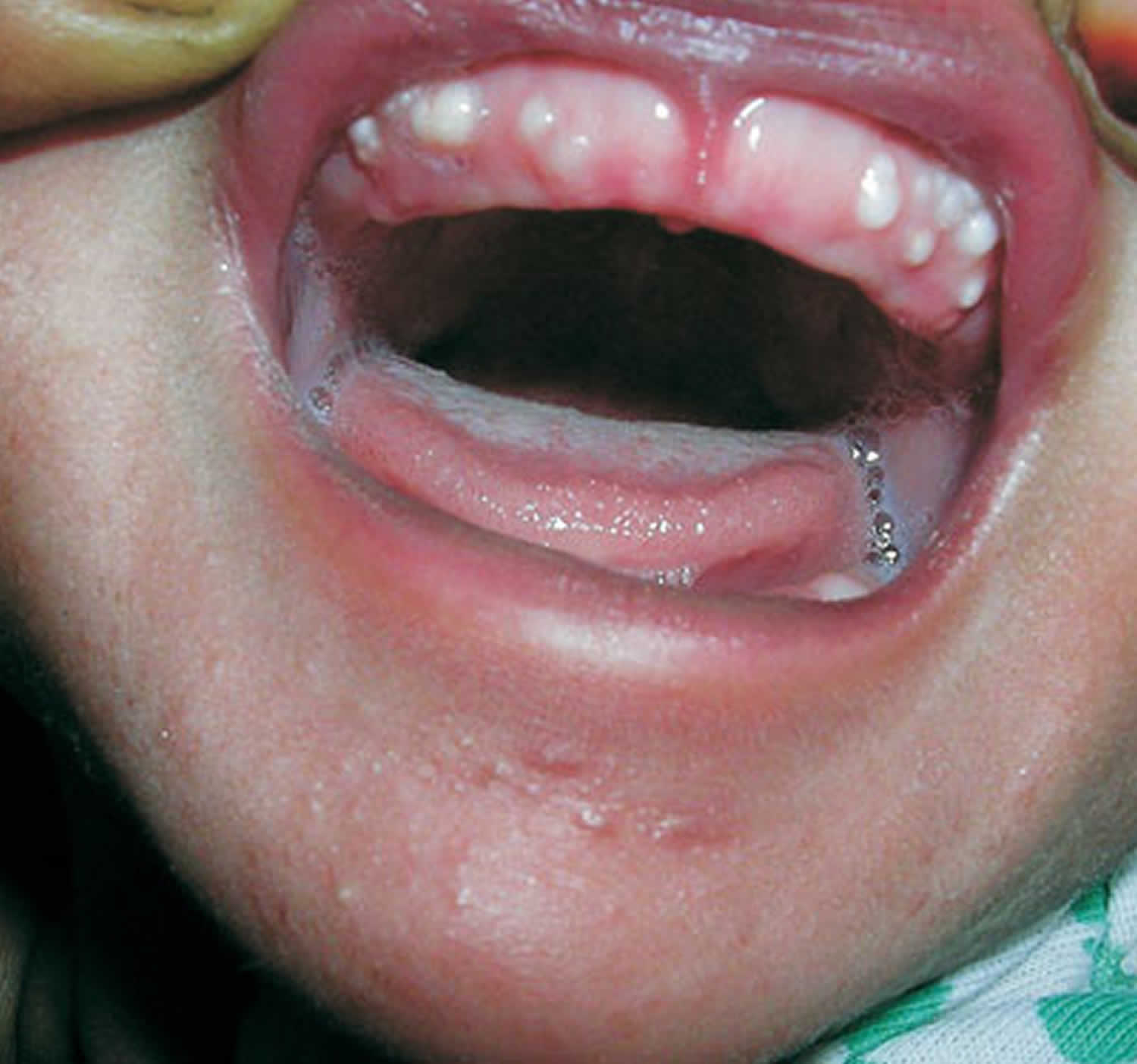 gingival-cysts-of-newborn-gingival-cyst-of-adult