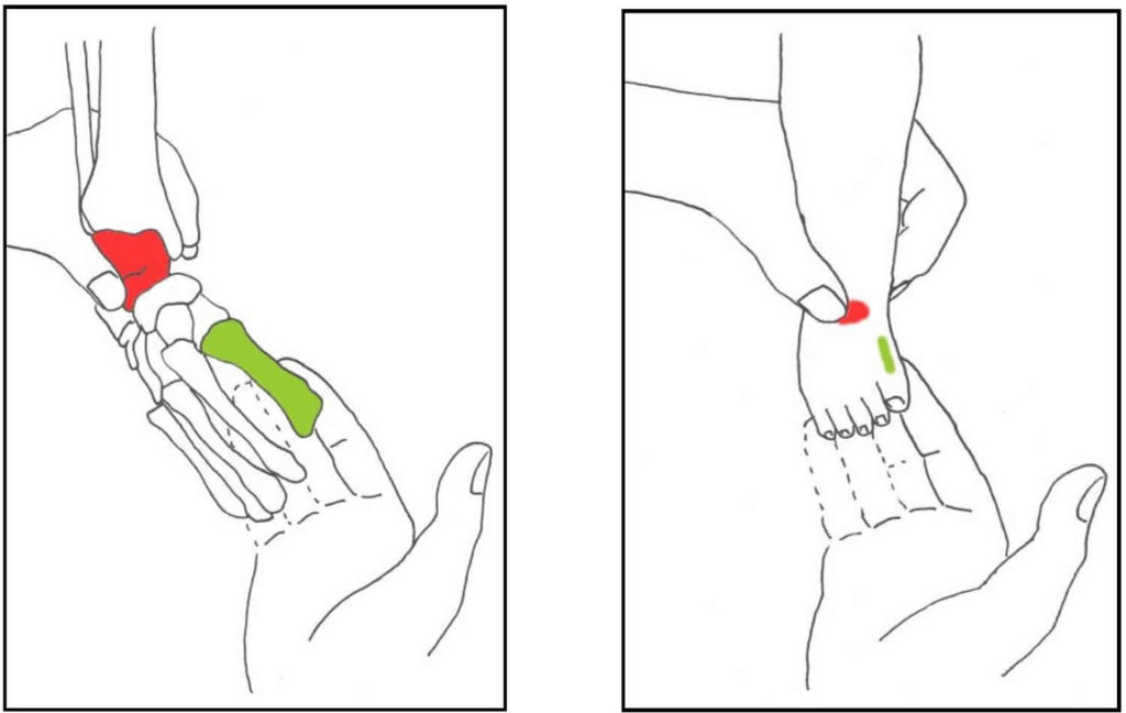 Ponseti Method For Clubfoot Treatment