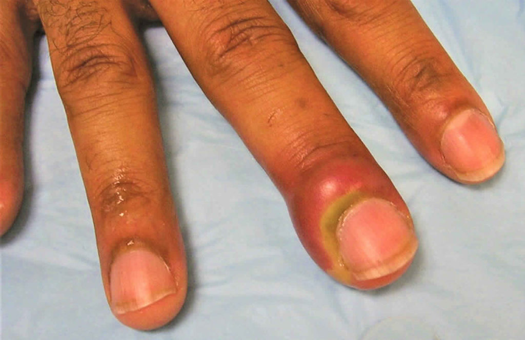 Hangnail & infected hangnail causes, symptoms, diagnosis & treatment