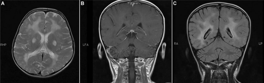 Subacute sclerosing panencephalitis causes, symptoms, diagnosis ...