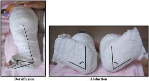 Ponseti Method For Clubfoot Treatment