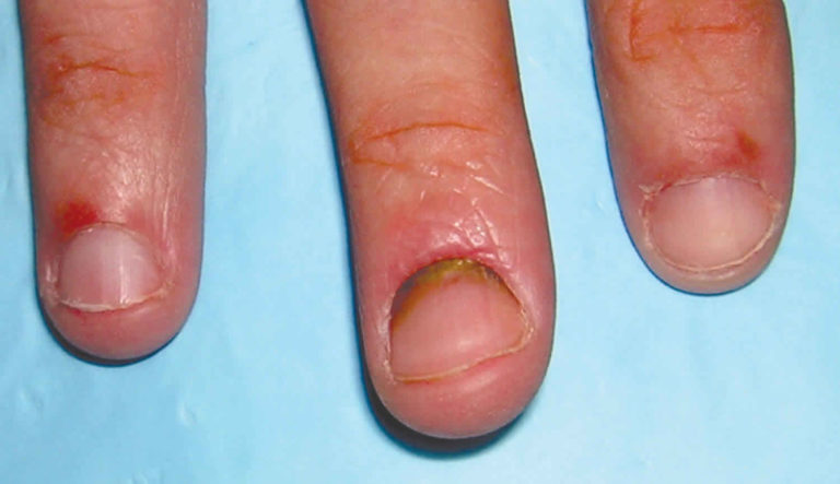 Hangnail & infected hangnail causes, symptoms, diagnosis & treatment