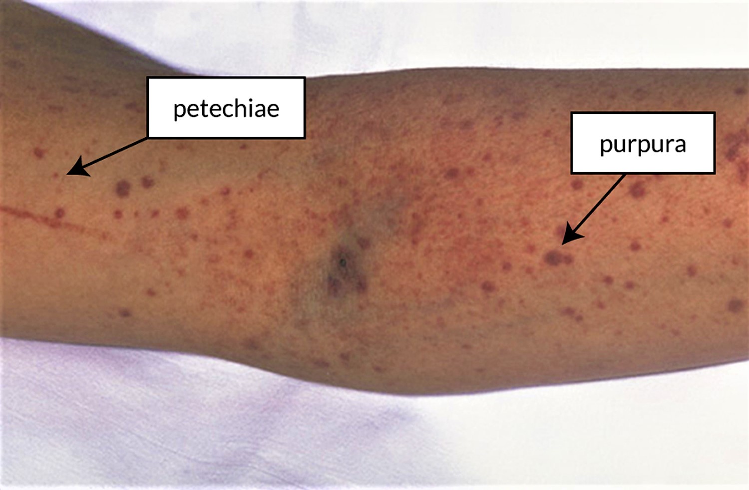 Disseminated Intravascular Coagulation Symptoms