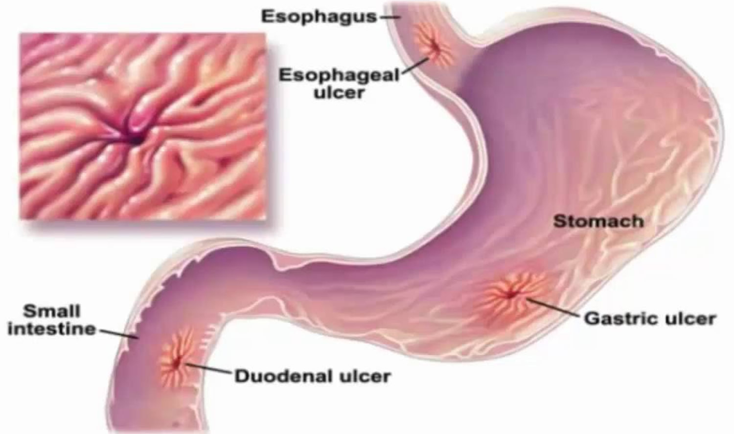 Stress Ulcer Causes Prophylaxis Symptoms Diagnosis Treatment 