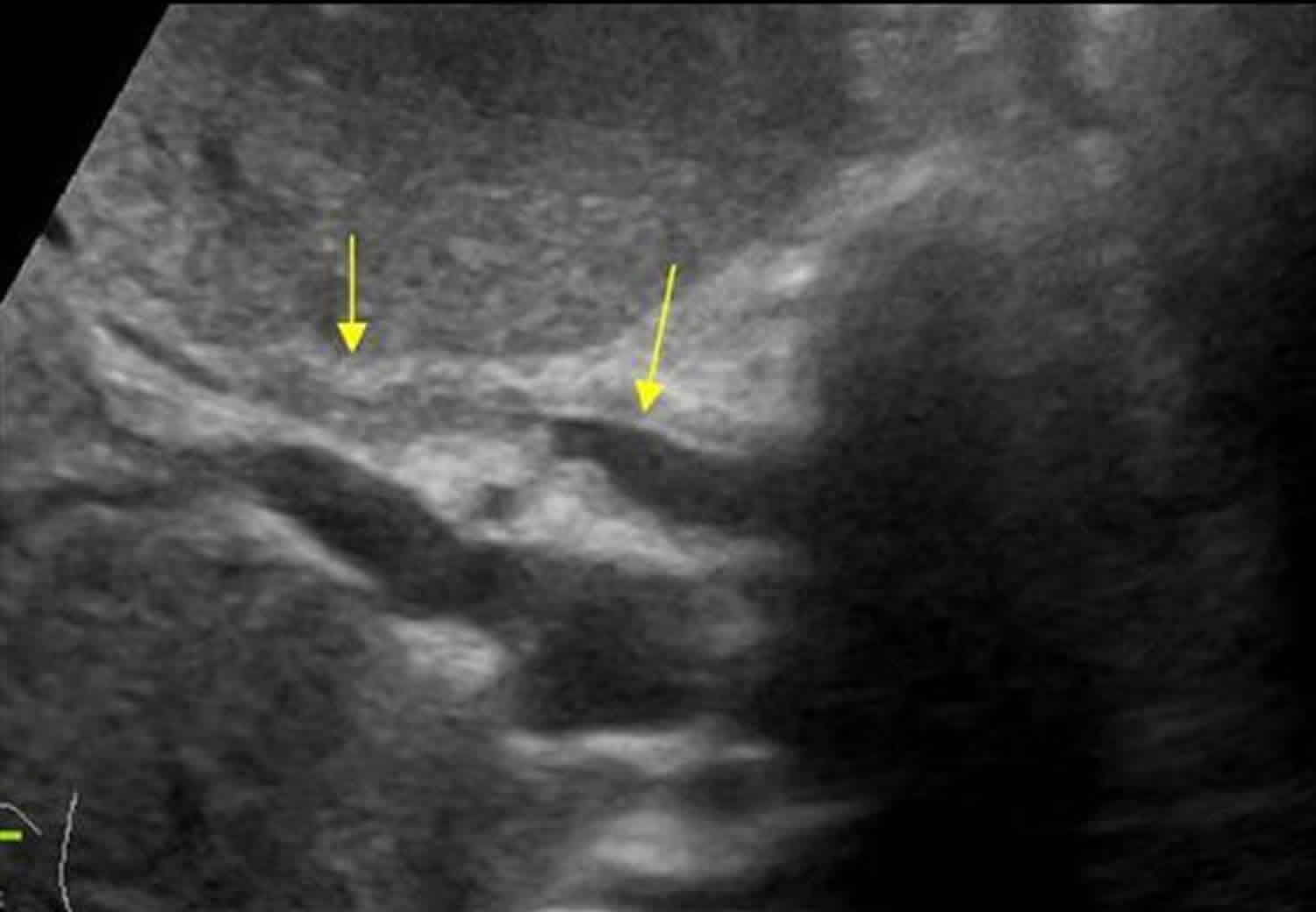 Ascending cholangitis