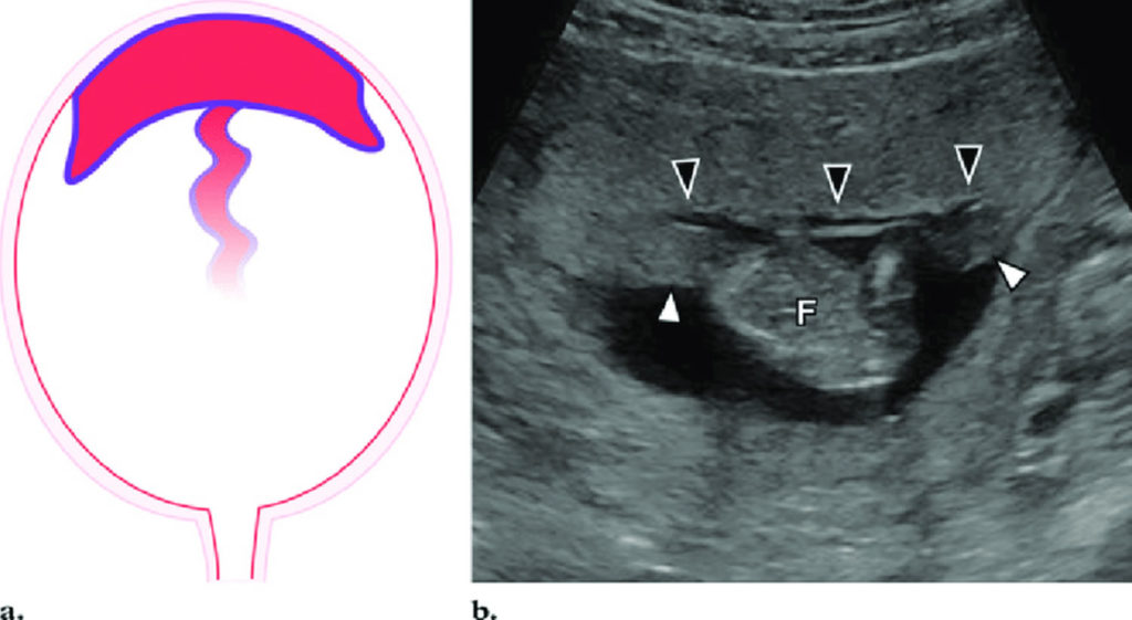 Circumvallate Placenta Symptoms, Diagnosis, Risks, Complications ...