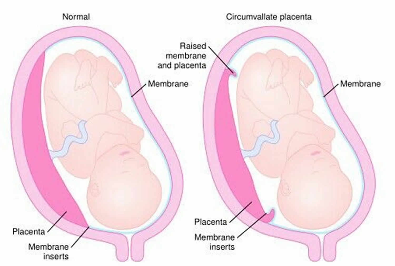 circumvallate-placenta-symptoms-diagnosis-risks-complications