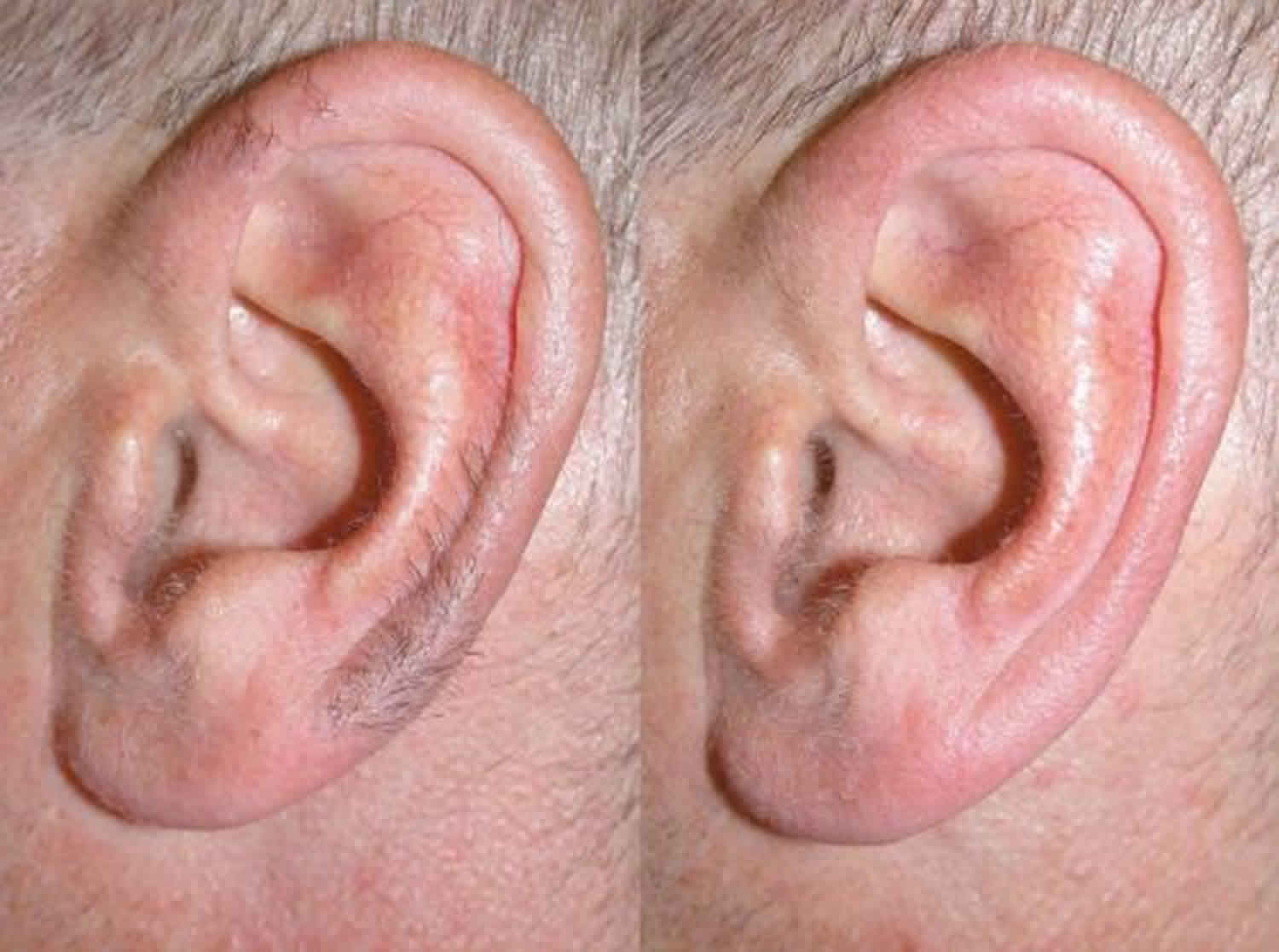 Ear hair function & ear hair removal techniques